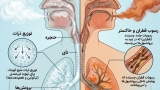 آیا ویپ بی‌خطر است؟ بررسی کامل مضرات ویپ، عوارض و مقایسه با سیگار